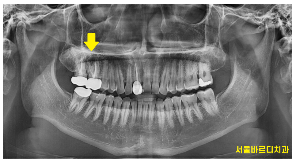 발치 대신 신경치료 뽑기 전 치료는 한번 해봐야하지않을까요? 관련 이미지 2