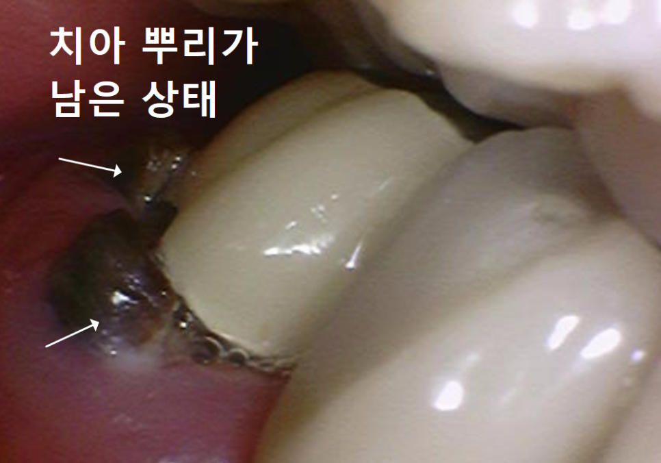 고덕동 어금니 브릿지 교체, 관련 이미지 6