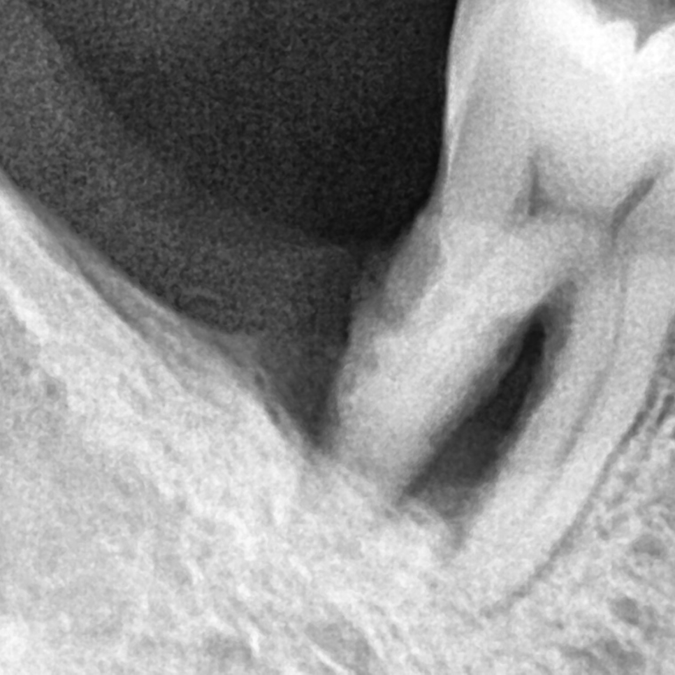 Gangdong-gu Dental Clinic: Are There Cases Where Implants Are Impossible? image 3
