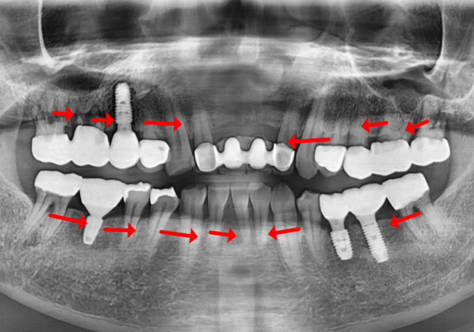 상일역 임플란트, 음식물 끼는 이유, 처음엔 안 그랬는데 왜 점점 심해지는 걸까요? 관련 이미지 2