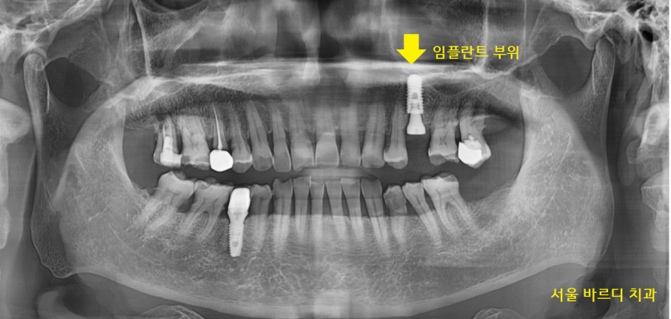 강일동 치과 치아 부러짐 붙일 수 있을까요?? 관련 이미지 5