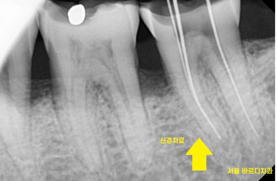 망월동 치과 신경치료 후 보철 꼭 씌워야 하나요?? 관련 이미지 4