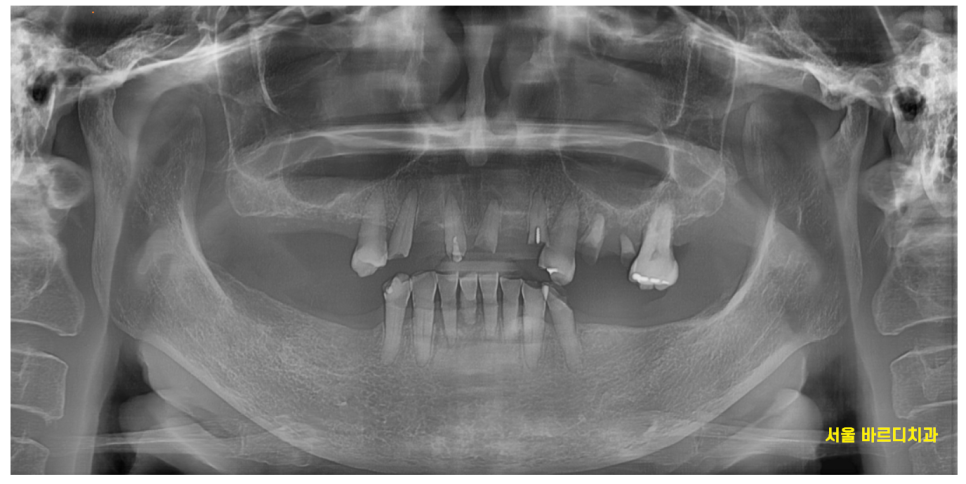암사동 치과 전악 임플란트 하루만에 끝냈습니다. 관련 이미지 2