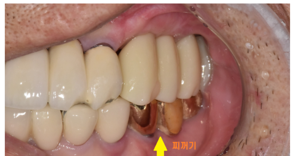 임플란트 vs 자연치아 이 그냥 뽑을까요? 라고 이야기는 환자분들께 관련 이미지 4