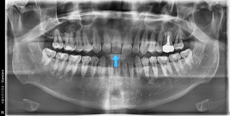 Gangdong-gu laminate failure and detachment: front teeth restored through retreatment image 2