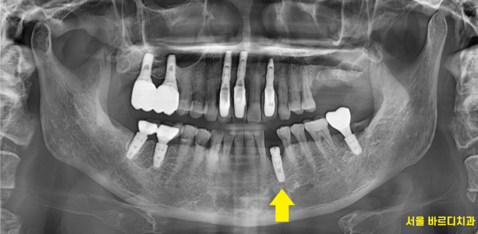 명일동 치과 심미적인 앞니는 하루만에 끝내는 빠른 임플란트로 하세요!! 관련 이미지 5