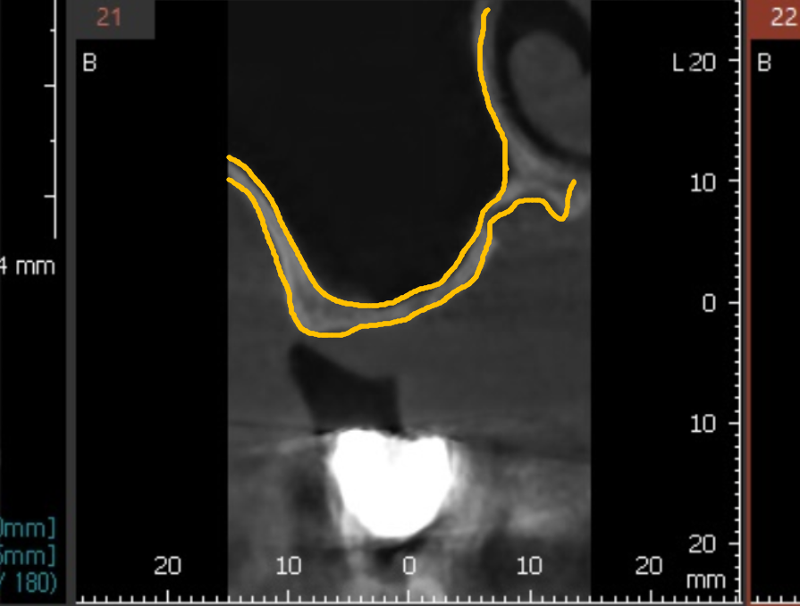 얇은 잇몸뼈, 임플란트 거부 당했다면? 상악동거상술로 해결할 수 있습니다. 관련 이미지 9
