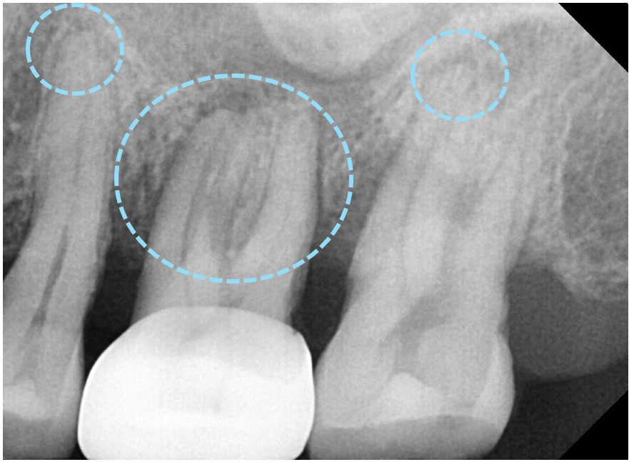 고덕동치과 서울바르디치과 무절개 네비게이션 임플란트 치료증례 #2 관련 이미지 5