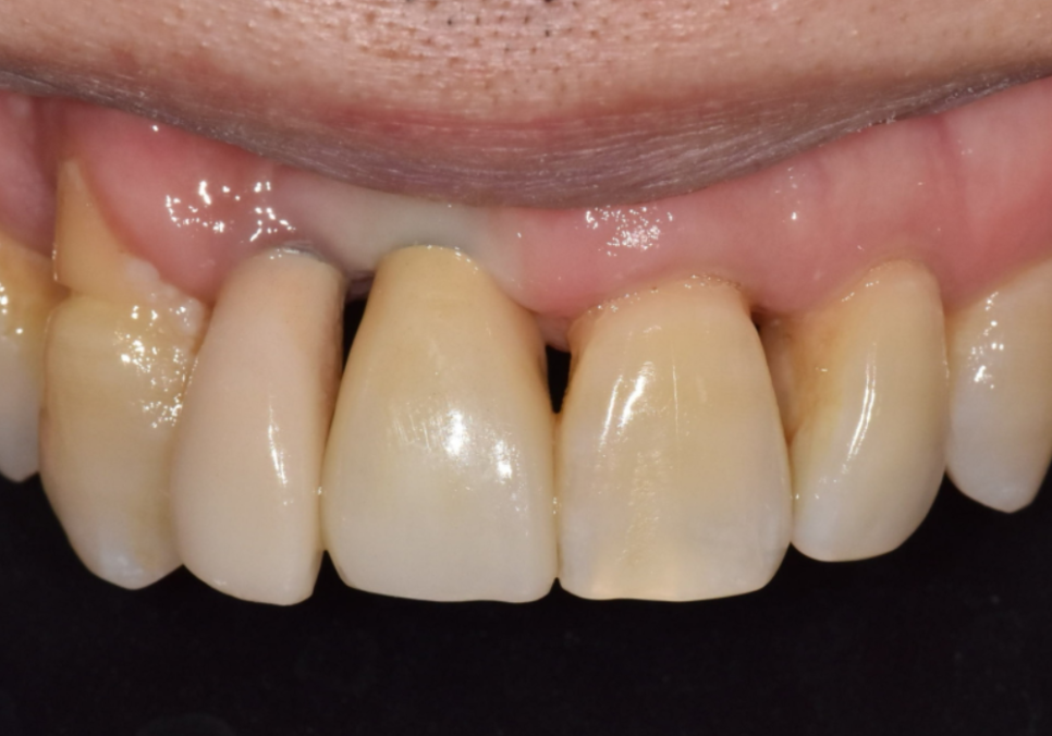 앞니 임플란트, 원내 기공소의 중요성을 아시나요? 관련 이미지 15