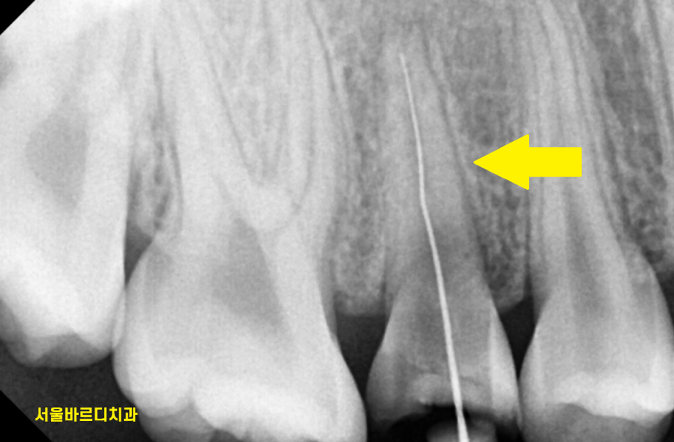 강일동 치과 추석 명절 딱딱한 음식은 절대 피하세요 치아 골절 생깁니다. 관련 이미지 5
