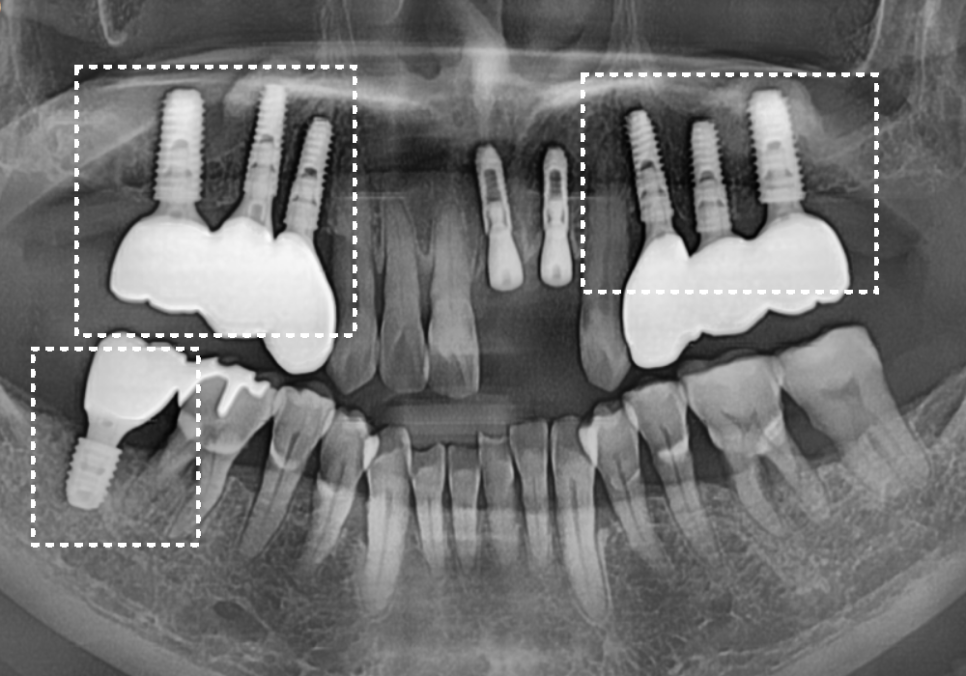 Gangil-dong Molar Implant, "It’s Loose—Can’t You Just Bond It with Resin?" image 16