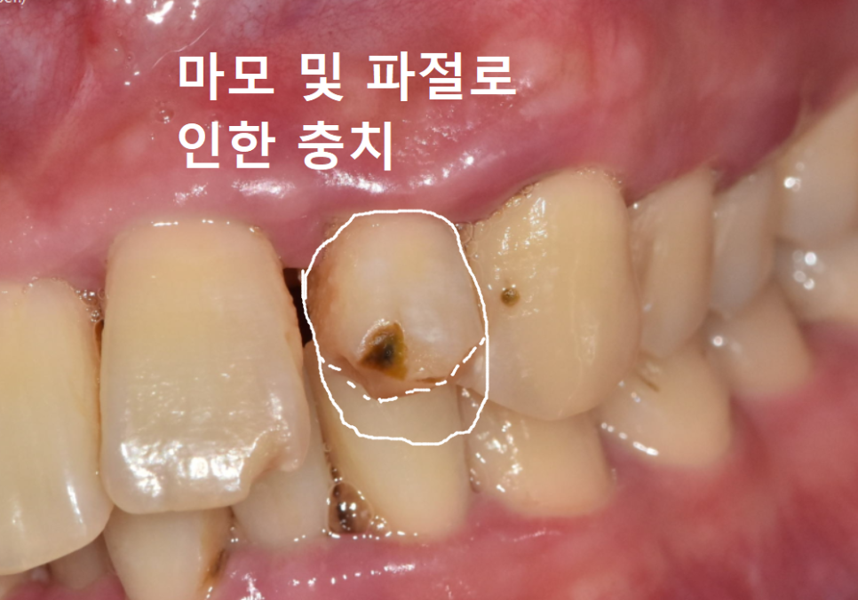 강동구 앞니 충치, 누구는 레진이고 누구는 임플란트인 관련 이미지 9