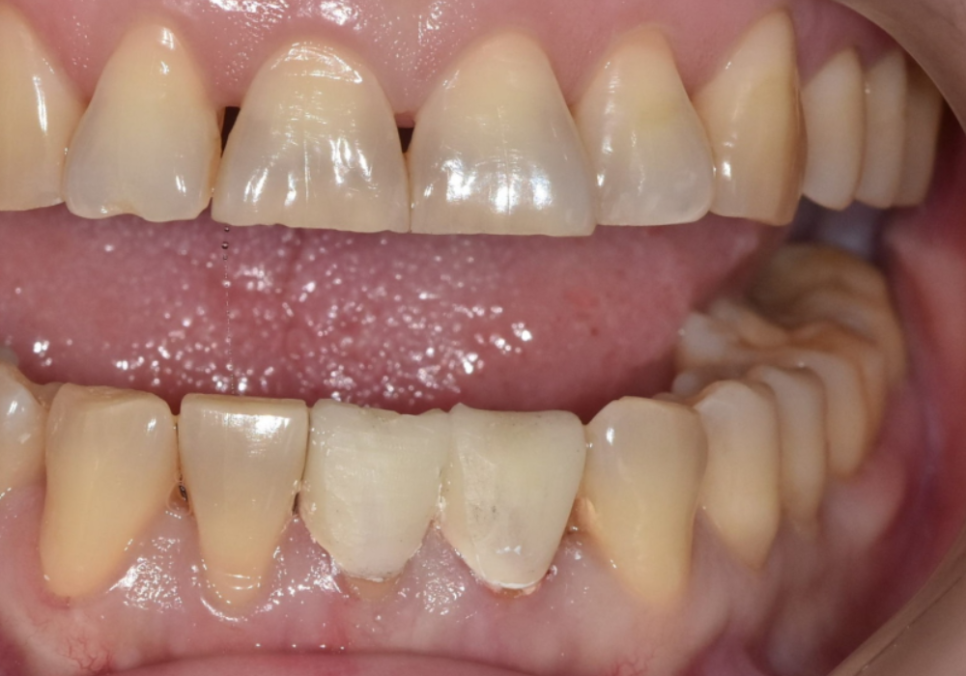 Spaces Between Front Teeth Due to Congenital Missing Teeth: Is Orthodontic Treatment the Only Answer? image 7