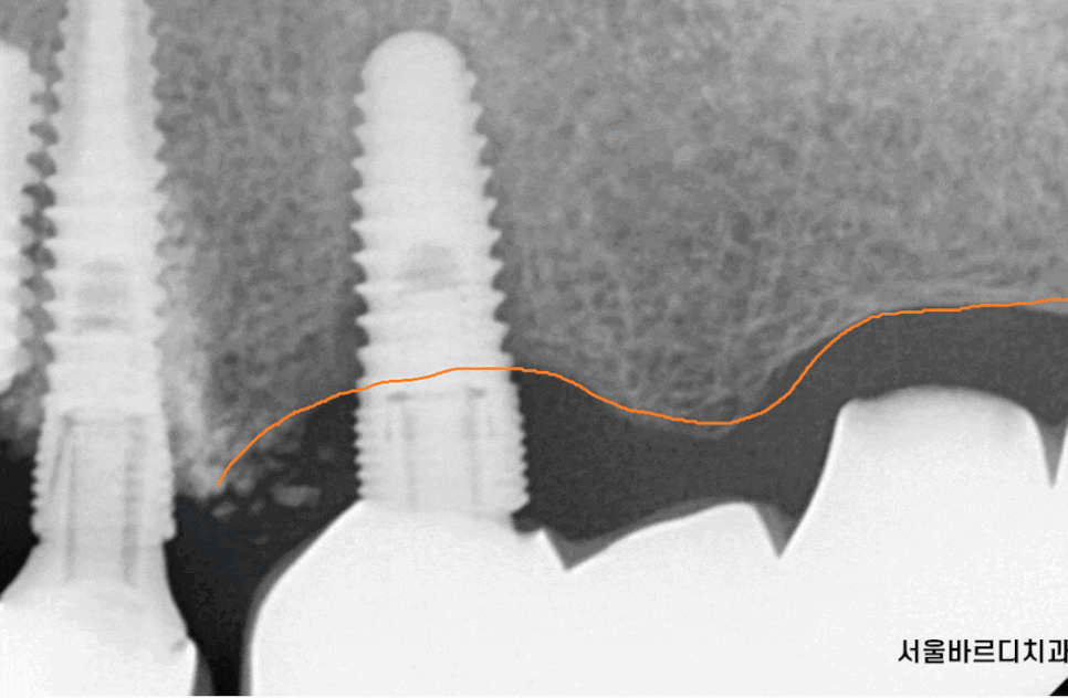 둔촌동 치과 임플란트 평균 수명 이것이 진짜 진실입니다 관련 이미지 1