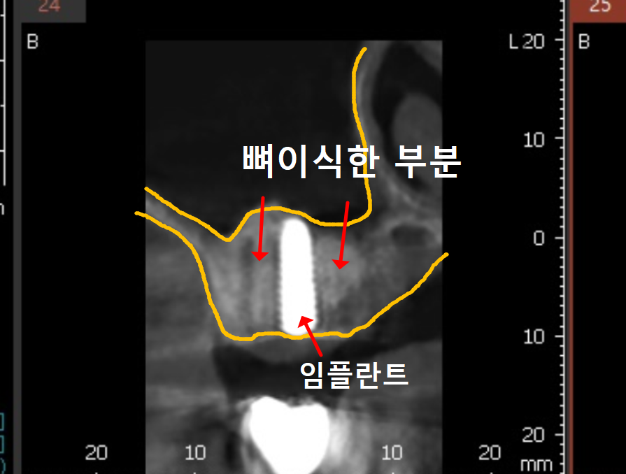 얇은 잇몸뼈, 임플란트 거부 당했다면? 상악동거상술로 해결할 수 있습니다. 관련 이미지 11