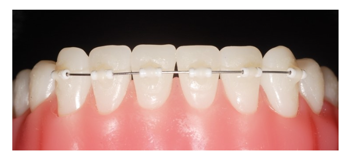 mta 장치 교정 앞니만 빠르게 심미적으로 정리할 수 있습니다. 관련 이미지 5