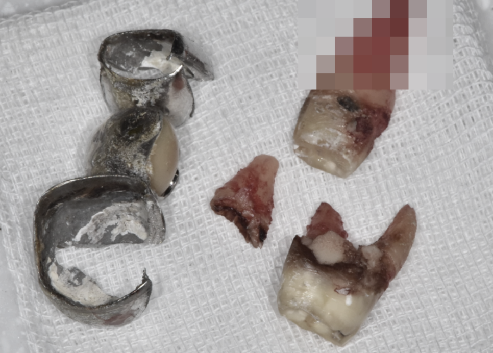 고덕동 치과치료 씌운 치아 문제가 생겼어요 관련 이미지 5