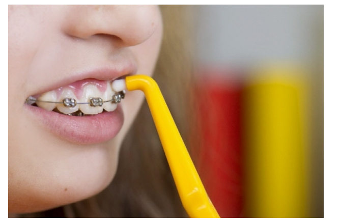 강동구 치아교정 아이들 방학 때 시작하면 좋은 이유 관련 이미지 3