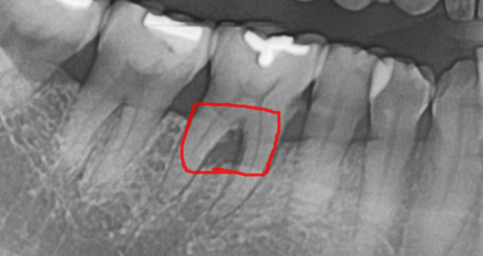 상일동 치과 치아 하나 빠지면 시작 됐을 수 있습니다 관련 이미지 5