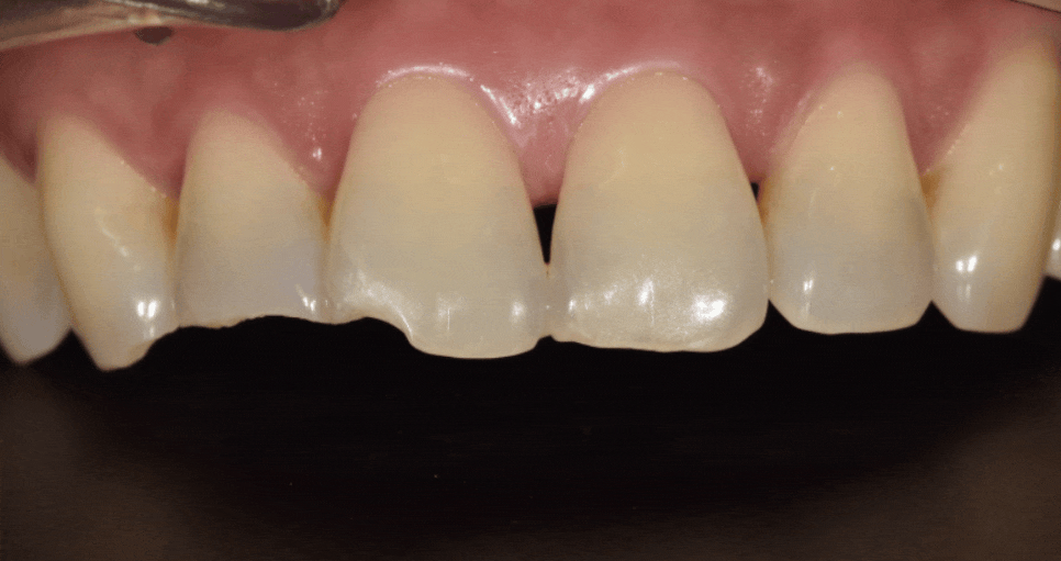 깨진 앞니 심미 치료, 라미네이트 vs 지르코니아 어떤 선택이 더 나을까? 관련 이미지 3