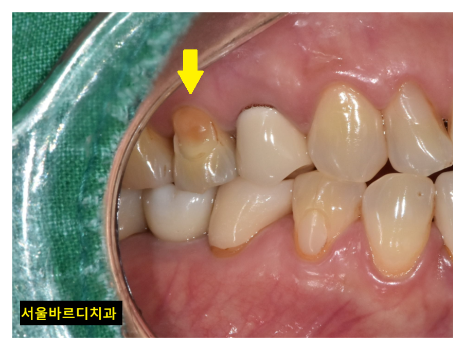 치아 옆면 파임 치경부마모증 치료해주어야하는 이유는? 관련 이미지 4