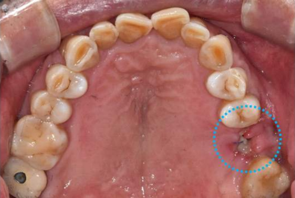 서울바르디치과 상하악 대구치 네비게이션 임플란트 치료증례 #4 관련 이미지 1
