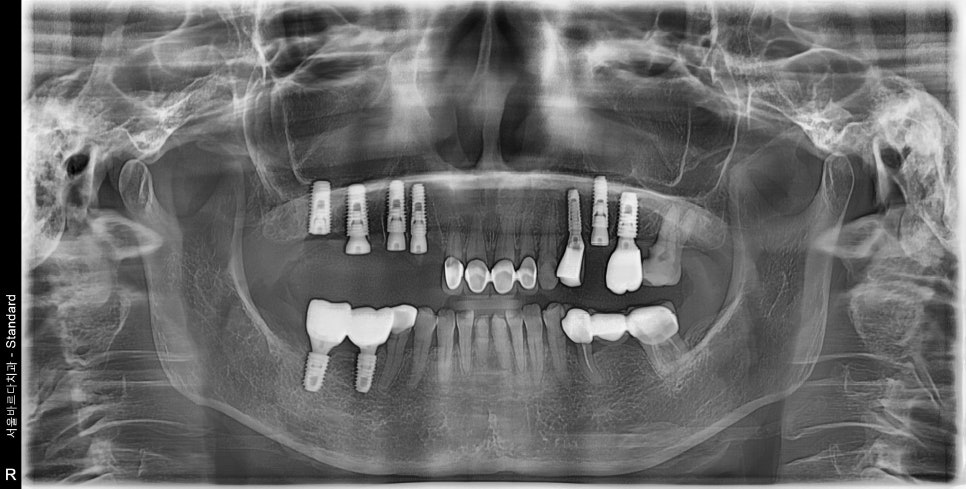 A Case of a 69-Year-Old Who Underwent Immediate Implant Placement After Extraction Due to Tooth Decay in Godeok-dong image 11
