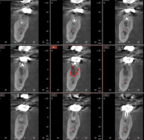 잇몸 물집 강일역 치과에서 원인 알아보고 임플란트로 치료했습니다. 관련 이미지 6