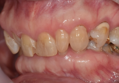 중장년 라미네이트, 70대도 가능한가요? 왜소치와 벌어진 앞니 해결 사례 관련 이미지 10