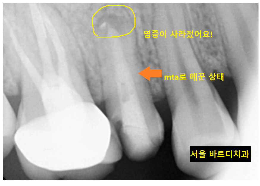 망월동 치과 재신경치료 자연치아 살리기 끝판왕 치료 mta로 가능했습니다. 관련 이미지 8