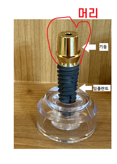 강동구 치과 임플란트 흔들림 나사 풀림 머리가 돌아가요!!! 대처법은? 관련 이미지 1