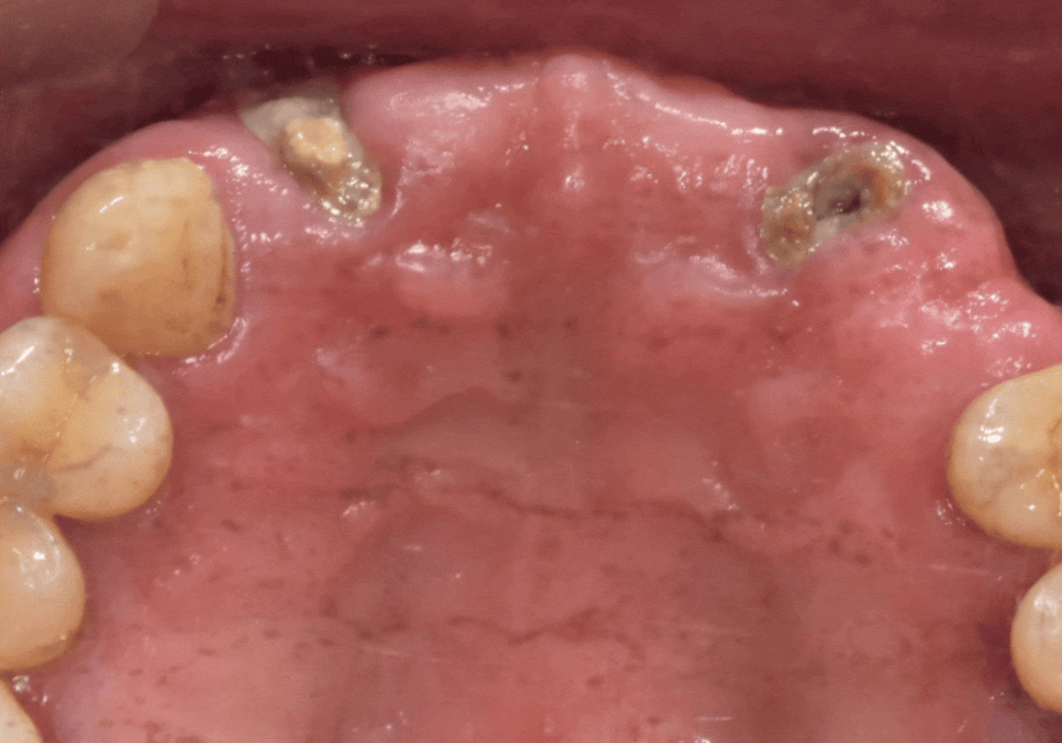 앞니 브릿지 부러짐, 이런 상태라면 절대 브릿지 다시 하지 마세요. 관련 이미지 5