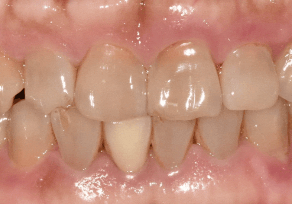 앞니 깨짐 치료 비용, 더이상 치과에 돈 낭비하기 싫다면? 깨지는 원인부터 알아야 합니다. 관련 이미지 8