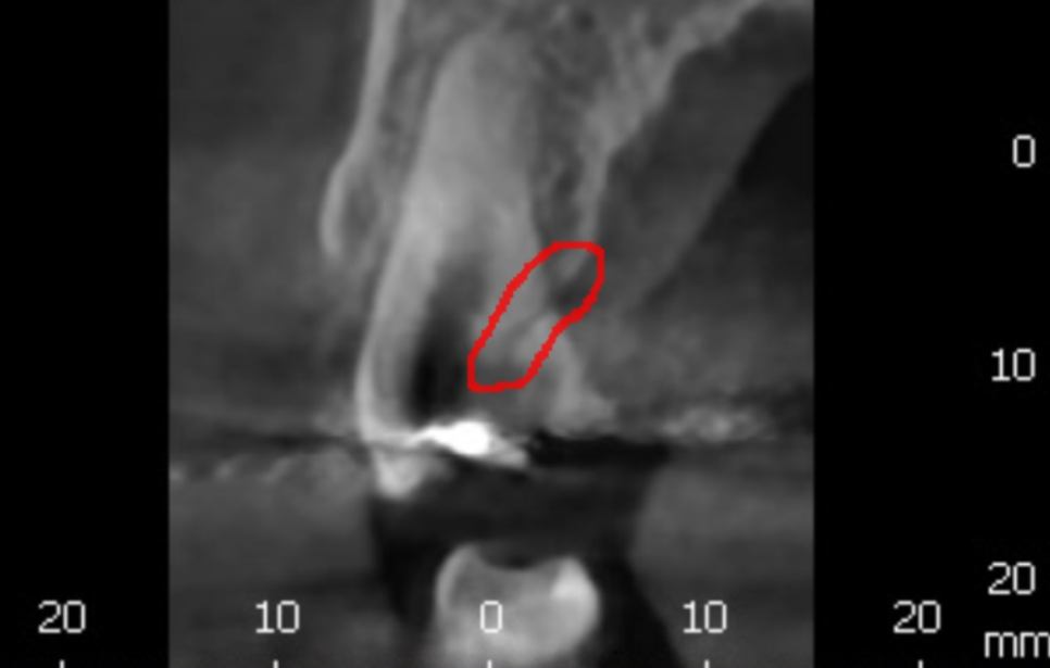 초이동 치과 치아 실금으로 조각나 신경치료까지 진행했습니다. 관련 이미지 4