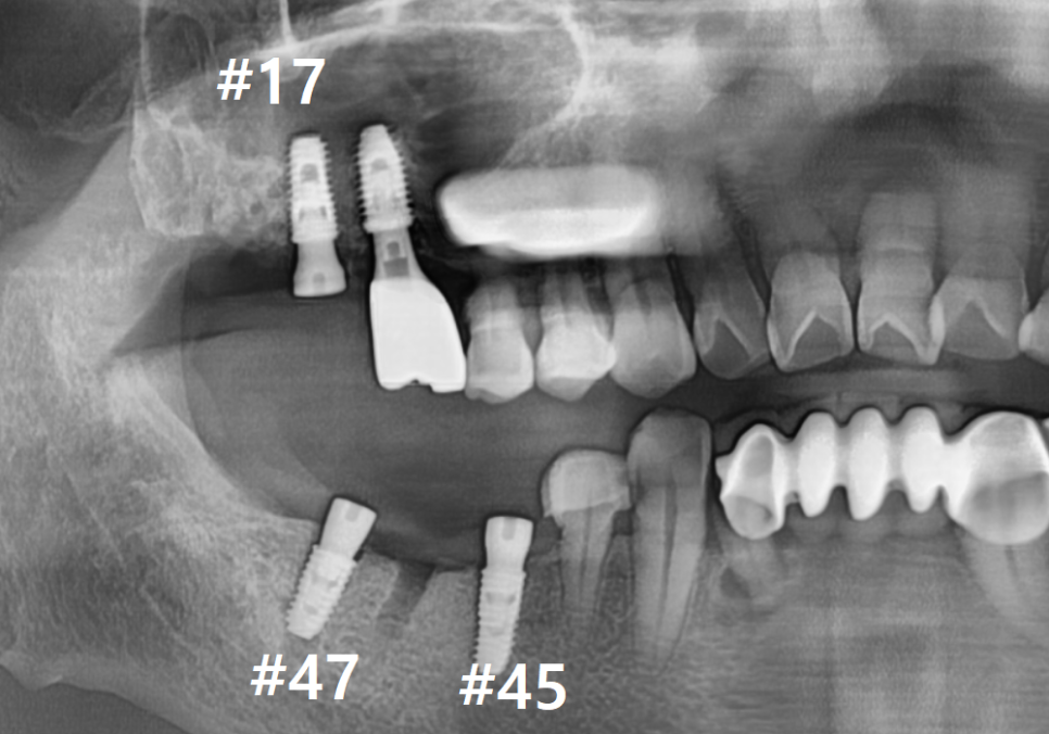 고덕동 어금니 브릿지 교체, 관련 이미지 11