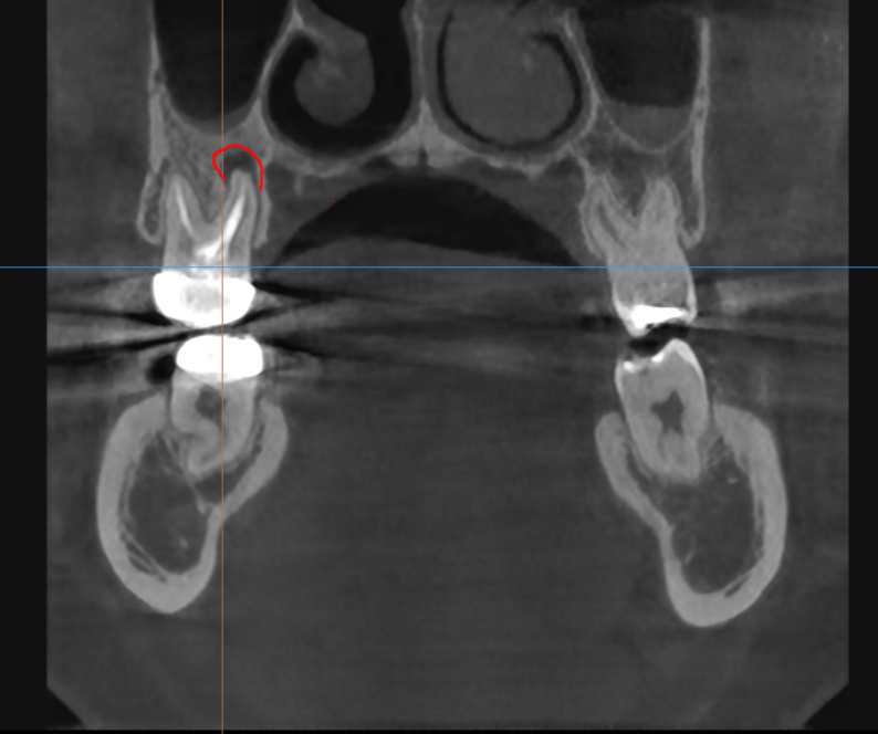 발치 대신 신경치료 뽑기 전 치료는 한번 해봐야하지않을까요? 관련 이미지 3