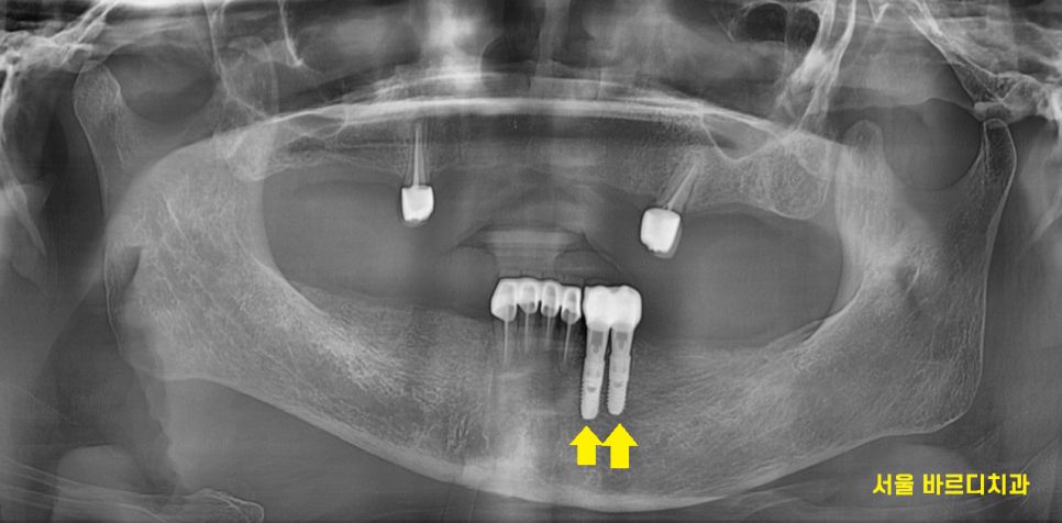 강일동 치과추천 틀니 사용중 치아 부러짐 임플란트로 복구했습니다. 관련 이미지 7