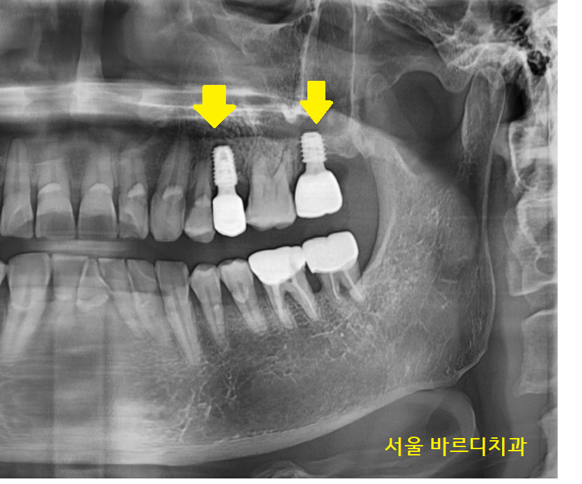 덕풍동 치과 임플란트 불가 판정받으신 환자분 살렸습니다. 관련 이미지 8