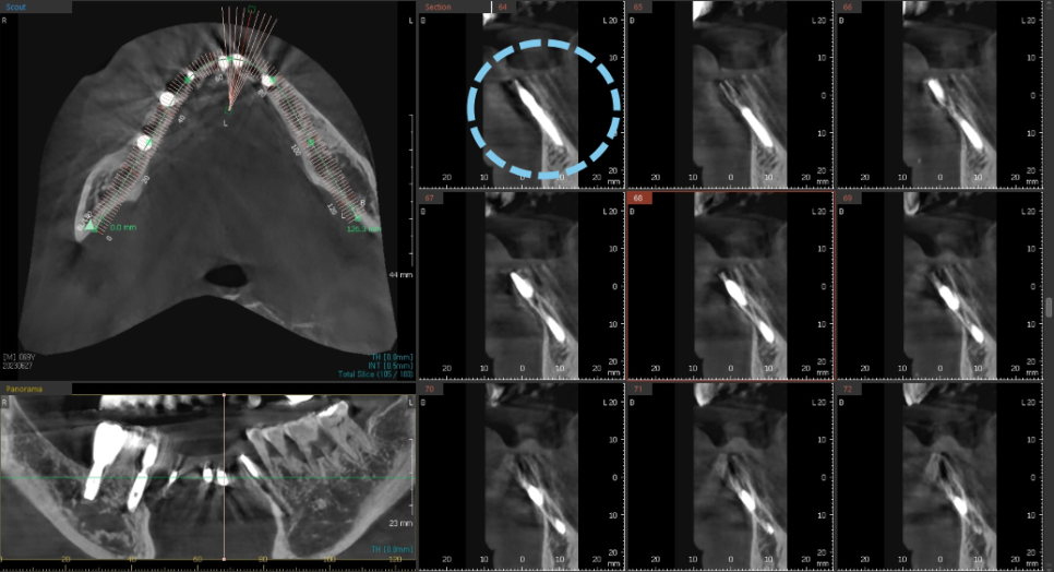고덕동치과 서울바르디치과 전치부 및 구치부 임플란트 치료증례 #10 관련 이미지 9