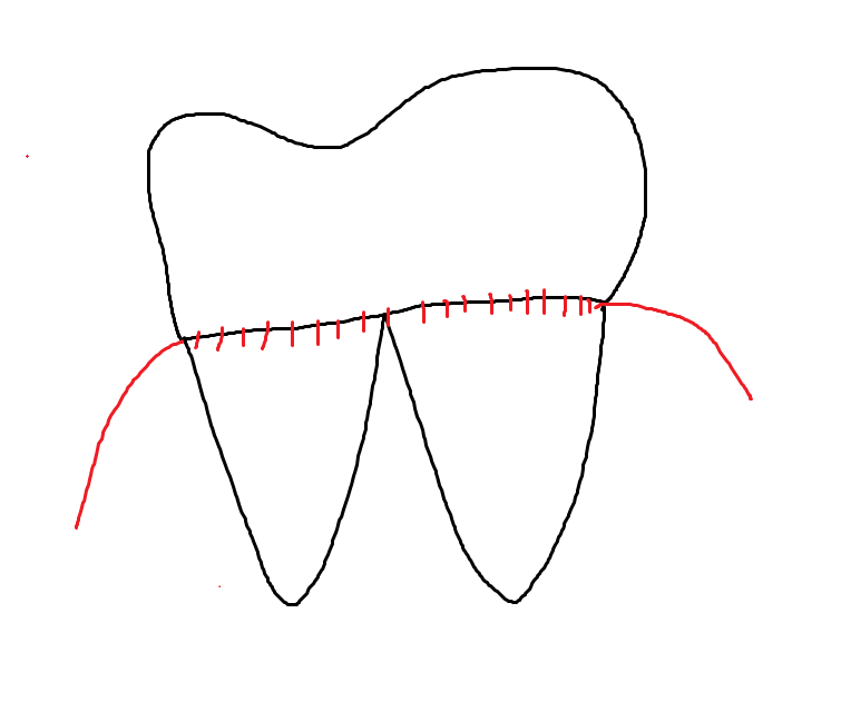 천호동 임플란트 치아 뿌리 충치가 파절을 유발하다. 관련 이미지 6