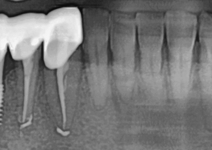 치아 뿌리 염증 빼야 된다는 치아, 이렇게 살렸습니다. 치료 방법 관련 이미지 7