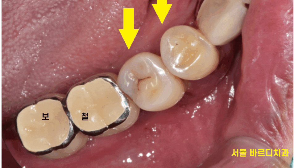 덕소 치과 발치 후 당일 뼈이식의 중요성 설명드립니다!! 관련 이미지 1