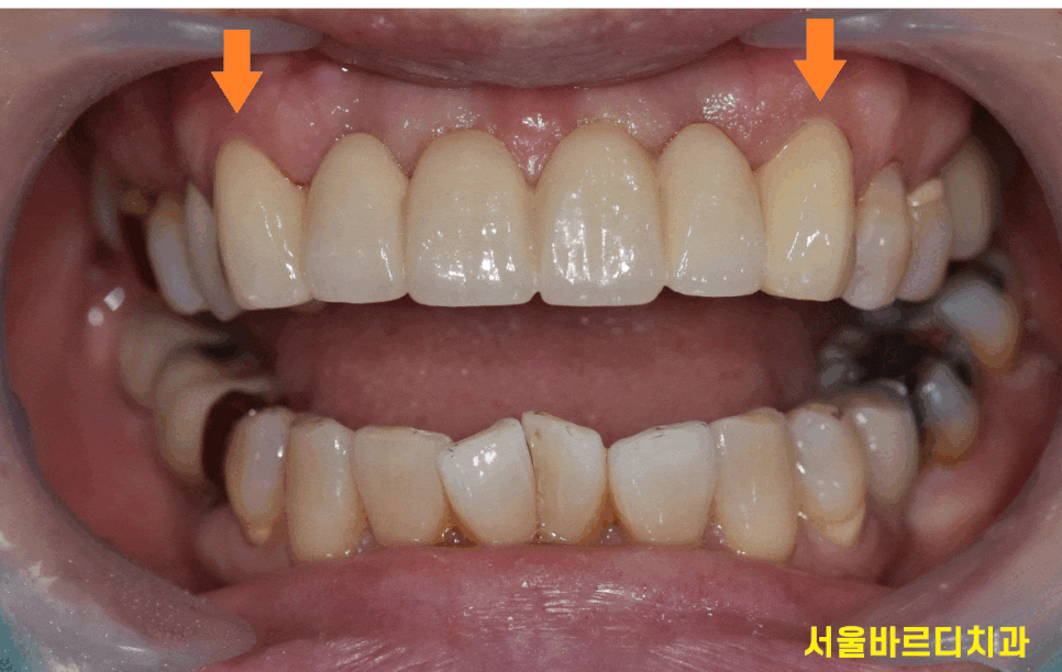 앞니 잇몸 검은색 라인 오래된 pfm 보철 교체하세요!! 관련 이미지 1