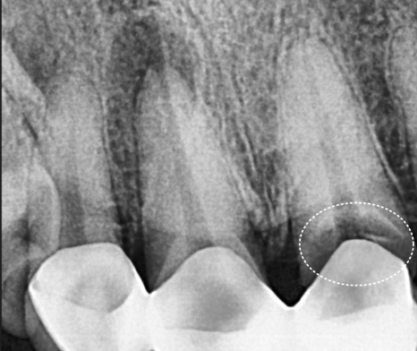 강동구 오래된 보철, 교체 시기는? 아프지 않은데 꼭 바꿔야 하나요? 관련 이미지 5