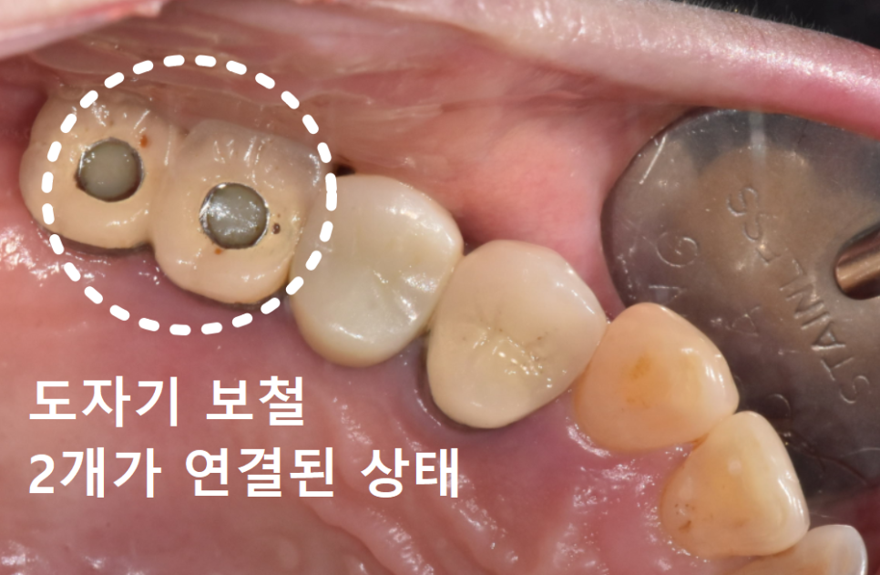 잇몸 고름 눌러보니 푹... 임플란트 주위염 방치했다가 재수술한 사례 관련 이미지 7