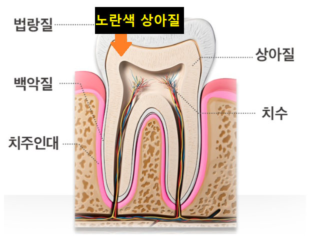 어금니 금감 발치 후 임플란트 풍산동 치과에서 진행했습니다. 관련 이미지 5