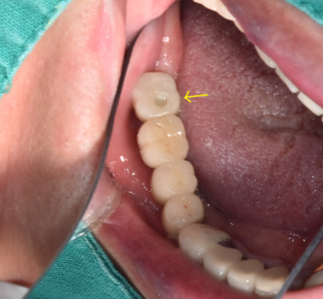 위아래 임플란트 동시에 하여 치료기간 단축하기 관련 이미지 10