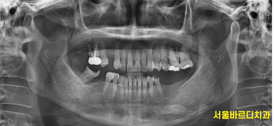 고덕동 치과 발치 후 방치하면 치아 쓰러짐 발생해요 관련 이미지 2