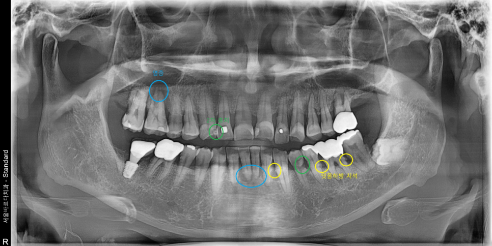 서울바르디치과 무절개 네비게이션 임플란트 치료증례 #8 관련 이미지 1