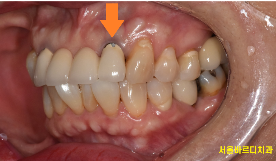 앞니 잇몸 검은색 라인 오래된 pfm 보철 교체하세요!! 관련 이미지 3